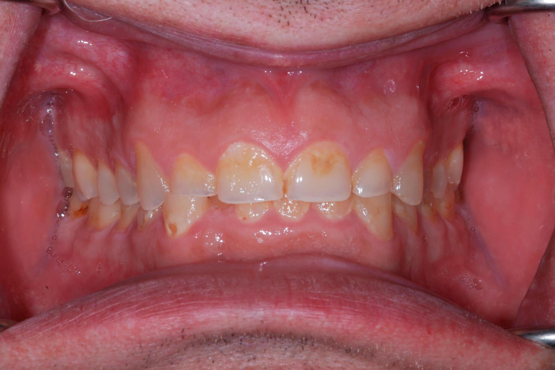 Tandlæge - Syreskadede tænder